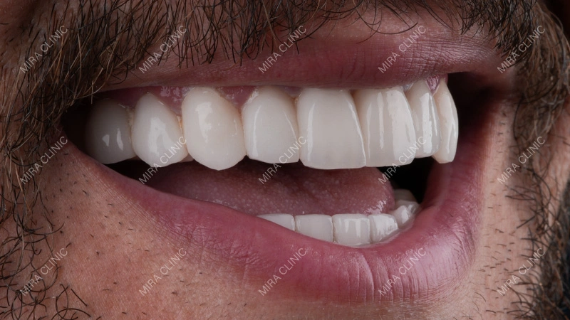 Zouhair Bahaoui’s New Smile